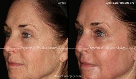 Laser Skin Resurfacing Before And After Photo Gallery New York City