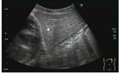 Hyperechoic Type Hemangioma Longitudinal Us Image Of The Liver Showing