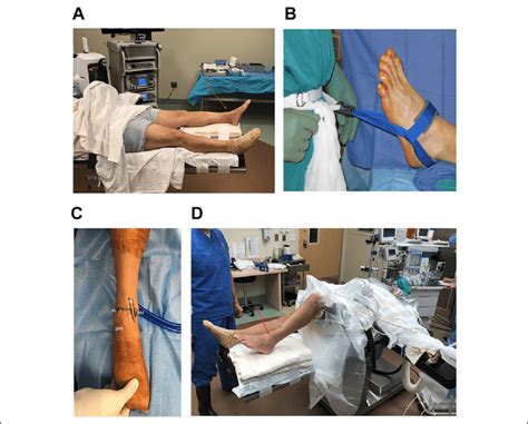 Supine Patient Positioning And Portal Designation A Supine Position