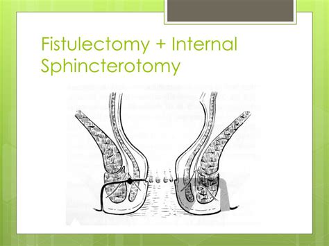 PPT The Best Surgical Treatment For Fistula In Ano PowerPoint Presentation ID