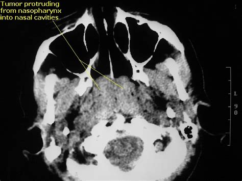 Pictures And Imaging Of Nasopharyngeal Lymphoma Otolaryngology Houston