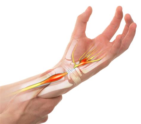 Tendonitis In The Wrist Panther Sports Medicine