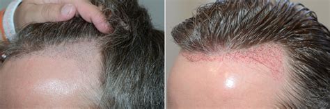 Hair Transplants For Men Reparative Hair Transplant Photos Miami Fl Patient