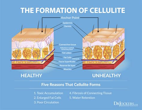 Top 10 Strategies to Get Rid of Cellulite Naturally - DrJockers.com