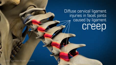 Cervical Neck Instability Regenerative Medicine And Prolotherapy For