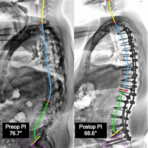 Lateral Radiographs Of A Primary Adult Idiopathic Scoliosis Showing A