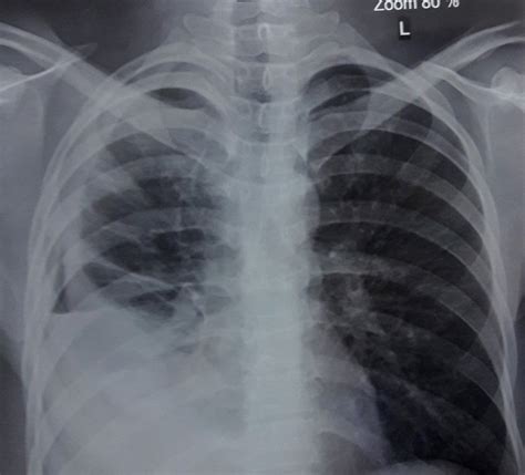 Chest X Ray Of Case 4 Showing Right Middle And Lower Lobe Opacity
