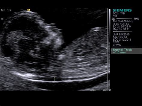 The number of fetuses and gestation sacs Nuchal Translucency - Siemens Healthcare Global