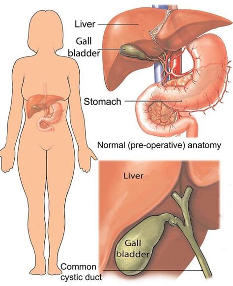 Open Cholecystectomy Surgery For Gallstones Benefits The Process