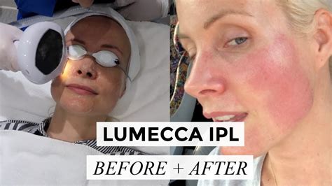 Lumecca Ipl Before After Liv Judd Youtube