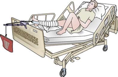 Chapter 8 from tom byrne, o.p.a.c., o.t.c., the common sense of traction. Nursing patients with musculoskeletal disorders | Nurse Key