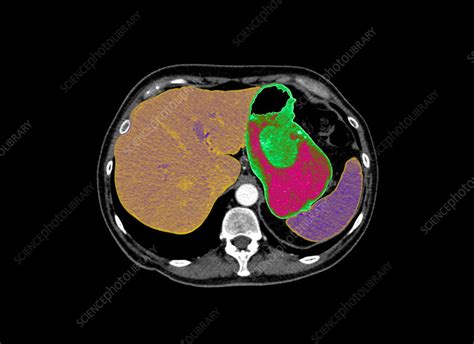 Stomach Cancer Ct Scan Stock Image C0261109 Science Photo Library