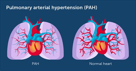 What Is Pulmonary Arterial Hypertension Pah Myphteam