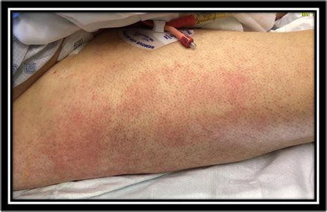 Rash Non Specifical Blanching Erythematous Rash On The Lower