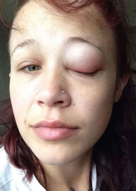 model whose eyeball tattoo went horribly wrong is very close to asking for eye removal irish