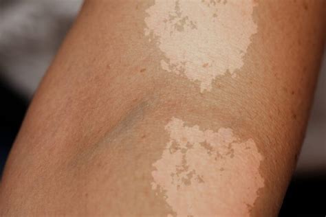 Tinea Versicolor Overview Causes Symptoms Treatment