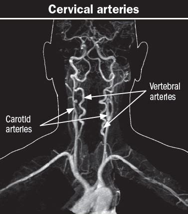 The carotid artery brings needed blood to your brain and face. When a pain in the neck is serious - Harvard Health