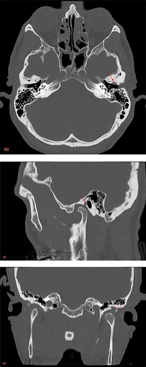 Noncontrast Computed Tomography A Axial B Sagittal And C