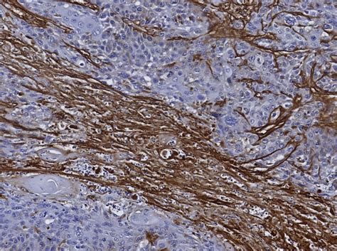 Immune Cells Held Hostage In The Tumor Stroma Ibv