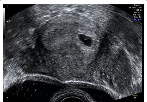 Intrauterine Gestational Sac With Yolk Sac Inside Download