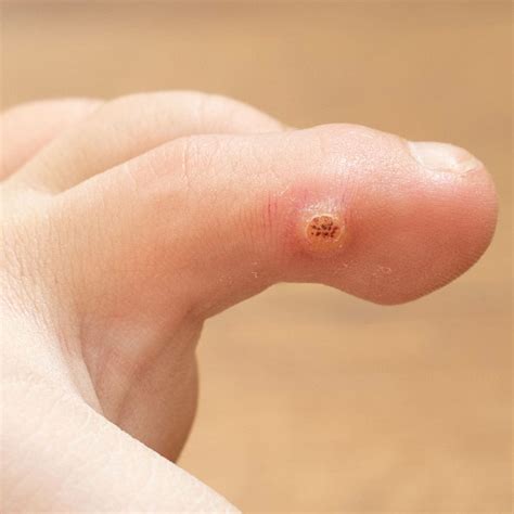 warts on your feet symptoms causes of plantar warts f