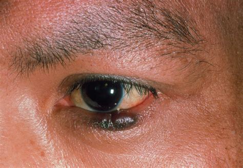 Kaposis Sarcoma On Lower Eyelid Of Aids Patient Photograph By Sue Ford