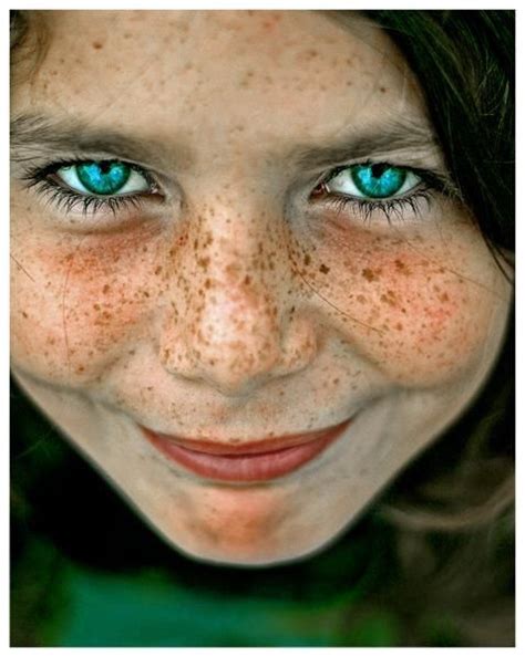 Exploring The Mystery Of Blue Freckles How Rare Are They And What Causes Them Justinboey