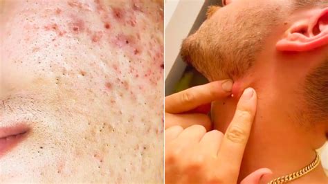 Popping Giant Pimple And Popping Huge Blackheads Best Pimple Popping