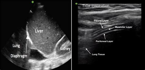 Diaphragm Ultrasound A Novel Approach To Assessing Pulmonar
