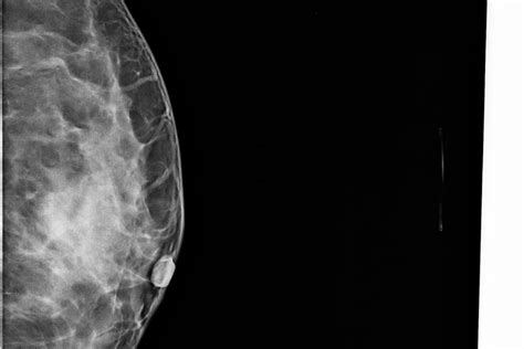 Mammograms Breast Cancer Images Ieee Dataport