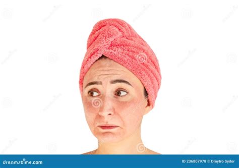 Face With Skin Irritation Acne Rash Or Sunburn Stock Photo Image Of