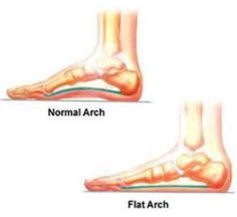 Overpronation Foot Problems How To Fix Flat Feet What Is