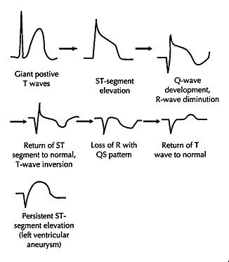 When we superimpose these two t waves ( c ) you can see why people say that the hyperkalemic t wave appears to be pinched (black arrows) in the middle compared to the normal variant. Doctors Gates: ECG changes in acute MI