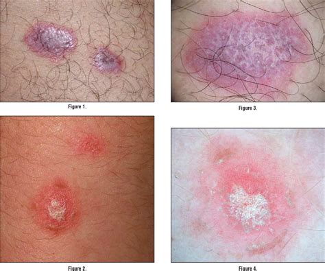 Figure 4 From Dermoscopy Subpatterns Of Inflammatory Skin Disorders
