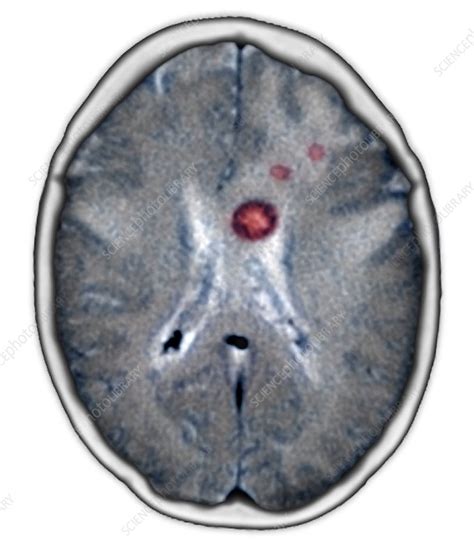 Secondary Brain Cancers Ct Scan Stock Image M1340510 Science