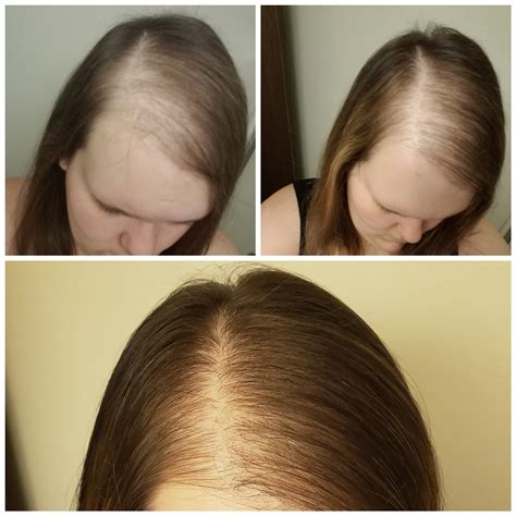 Beginning 3mo And 6mo After Treatment For Female Pattern Baldness