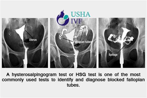 Tubal Testing By HSG Hysterosalpingogram HSG Test For Tubal Infertility