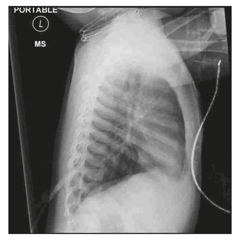 A Right And B Left Lateral Decubitus Chest X Rays Taken After The
