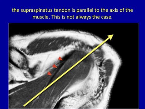 Mri Musculo Skeletal Section Mri Anatomy Of The Shoulder Axial View