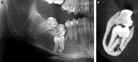 Mandibular Sagittal Split Osteotomy For Removal Of Impacted Mandibular