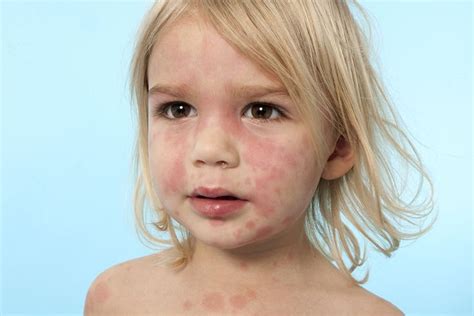 10 Common Childhood Rashes How To Treat Hives Hives Rashes In Children