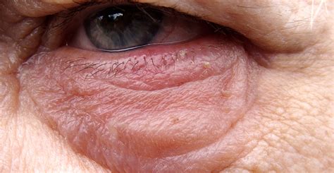 Eyelid Skin Cancer Signs Dr John Burroughs Colorado Springs