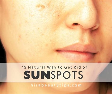 19 Natural Ways To Get Rid Of Sunspots On Face With Images Sunspots On Face Spots On Face