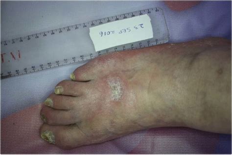 Ischemic Diabetic Foot Ulcer Note Characteristic Punched Out