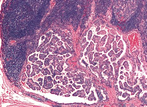 Papillary Thyroid Cancer Lymph Node Metastasis Neamtu Marius Cristian