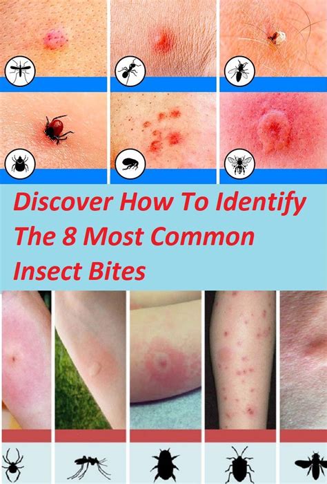 Discover How To Identify The 8 Most Common Insect Bites With Images Insect Bites Bug Bites