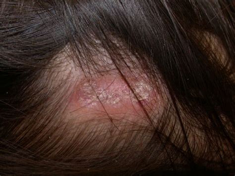 Figure Discoid Lupus Scalp Dermnet New Zealand Statpearls Ncbi
