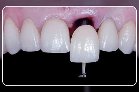 Coroas de transição em Implantodontia uso do dente do paciente