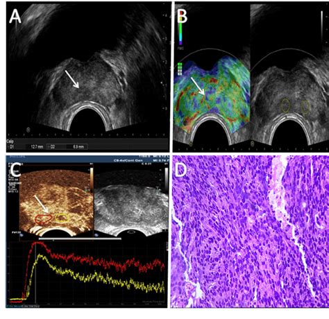 Ultrasonography Of Prostate Cancer A Transverse Transrectal