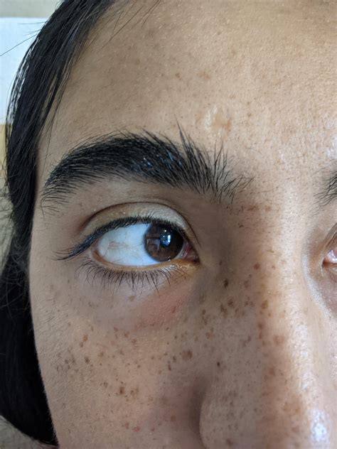What Is This Bump On My Eyebrow That Wont Go Away Eyebrows